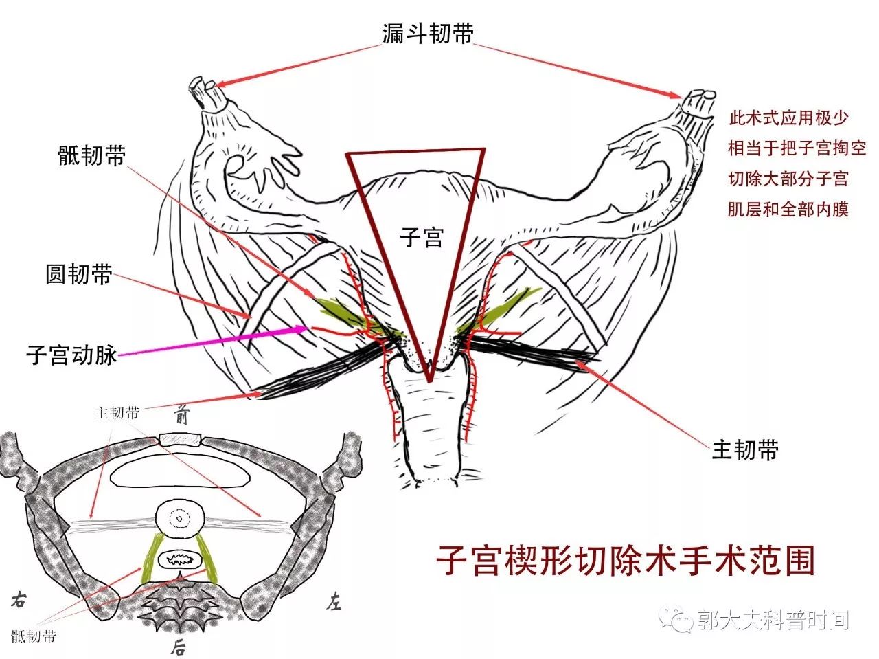 同样是子宫切除，切多一点，切少一点，区别是很大的！