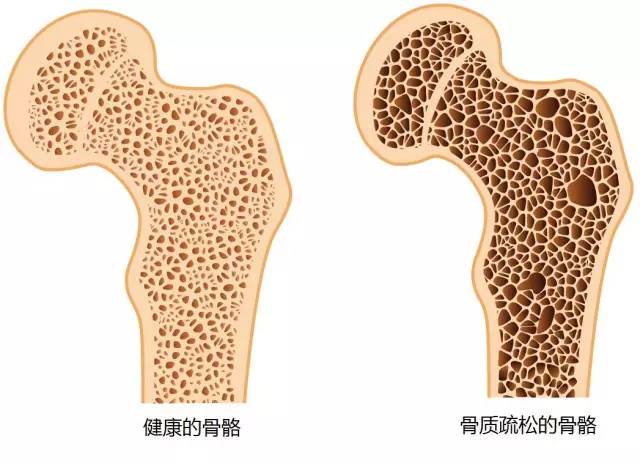 打完激素会骨头酸吗,长期打激素药对人体有什么危害