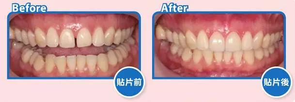 牙缝大的人漏财,牙缝变大有漏财说法吗