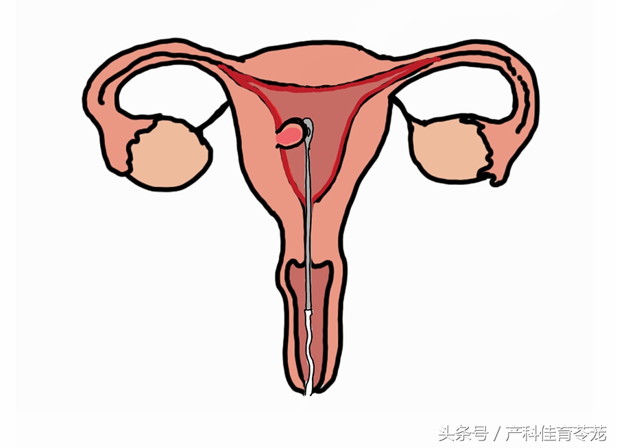 卫生部人工流产术操作教学,微管可视无痛人工流产术全过程