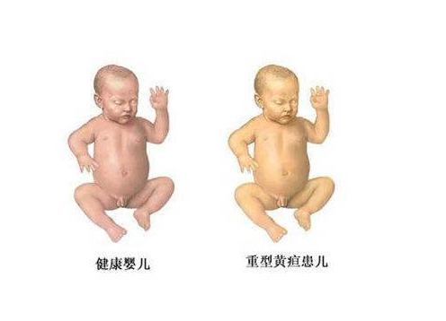 宝宝出现黄疸怎么办？让我来告诉你怎么自我治疗