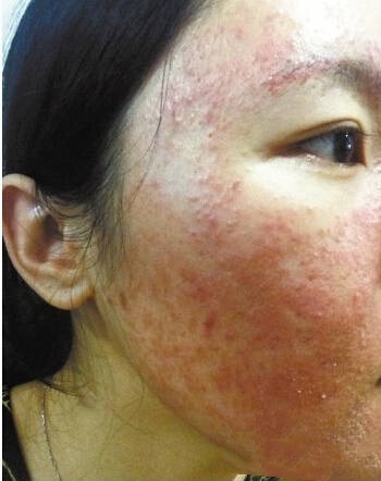 皮肤屏障修复朵嘉浓,朵嘉浓激素脸靠谱吗