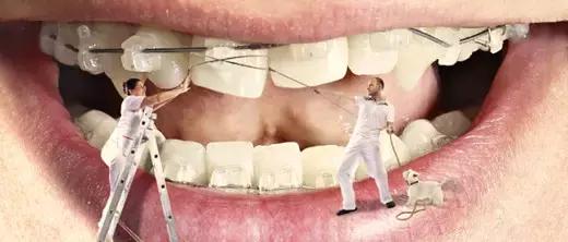 牙套上钢丝了好痛怎么办,牙套上钢丝很紧