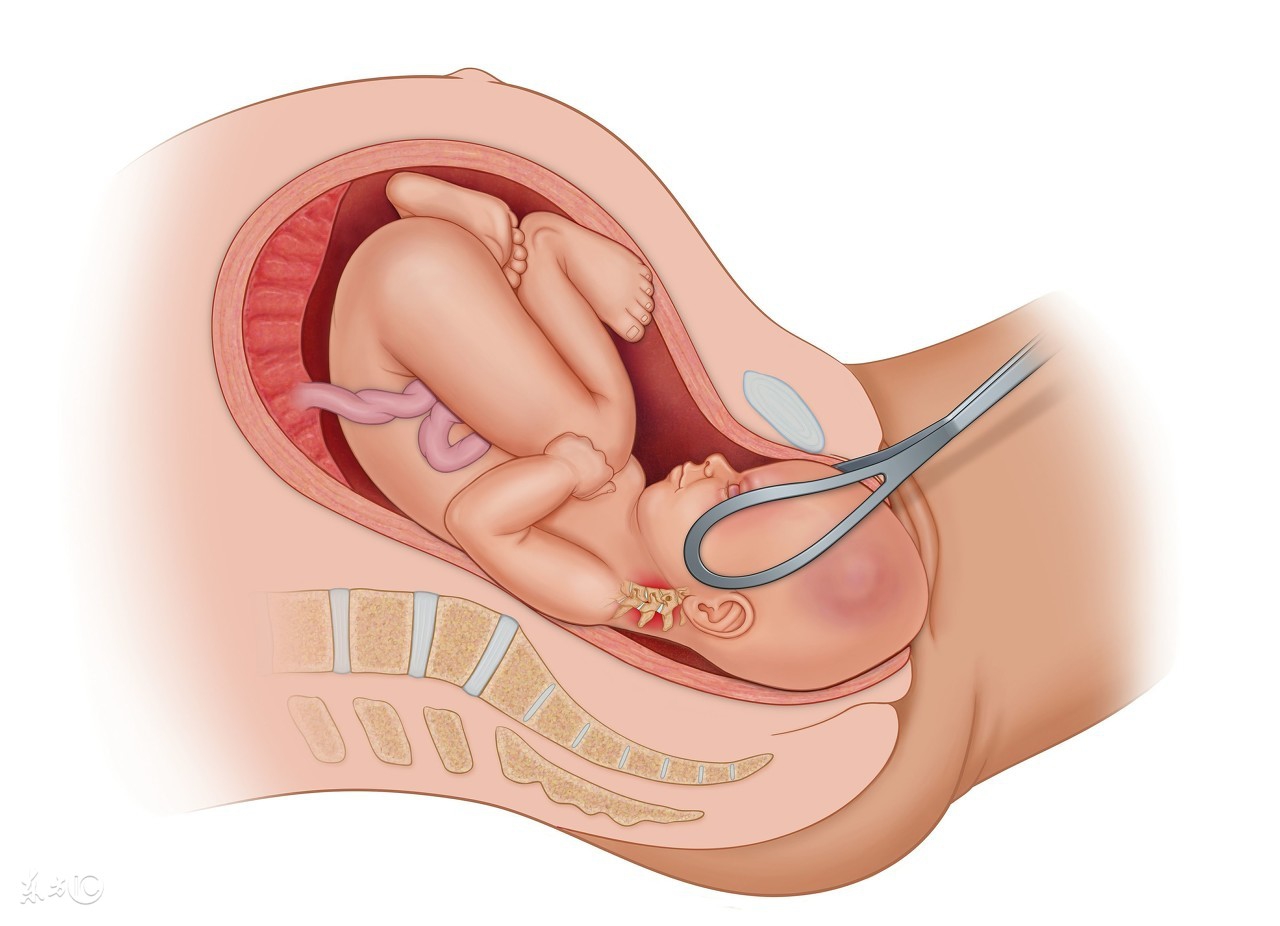 胎儿脐带绕颈要怎么才能绕回来,36周脐带绕颈2周后期能绕回来吗