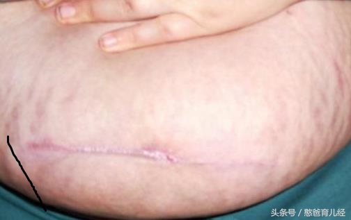 女人剖腹产后会容易得腰酸的病吗,女人剖腹产后期危害