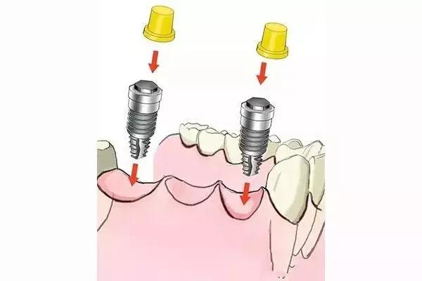 缺牙是种植牙还是烤瓷牙好,烤瓷牙和种植牙哪个保持时间长