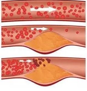 血管堵没堵看这里就知道了,吃肥肉容易堵血管吗
