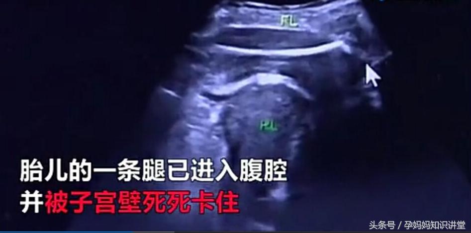 急救胎儿踢破子宫,胎儿一脚踢破子宫怎么办