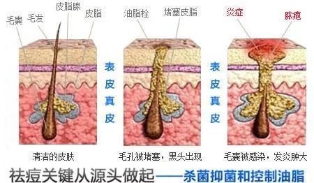 怎样可以预防痘痘和祛痘痘,非常大的痘痘怎么根除原因是什么