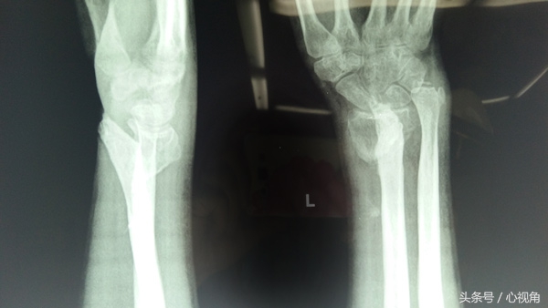 手腕骨折后畸形怎么治,骨折后外敷中药脱皮