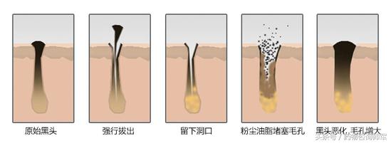 如何祛黑头白头粉刺,如何祛黑头白头
