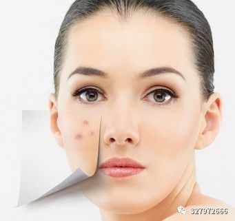 朵嘉浓修复激素脸案例,朵嘉浓修护激素脸