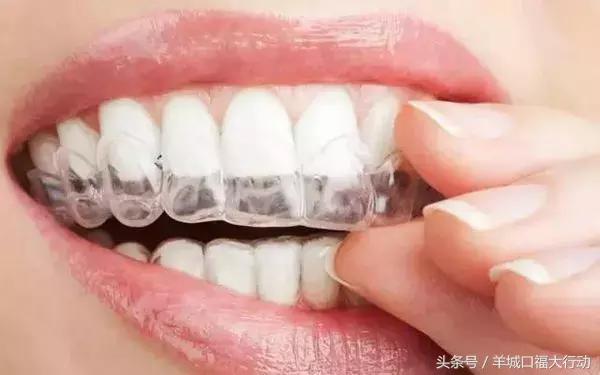 隐形矫正牙齿的注意事项,隐形牙套佩戴注意事项短视频