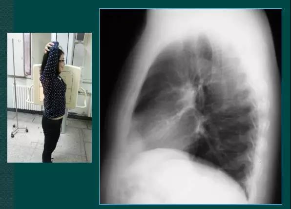 读完该文,让你学会如何看胸片