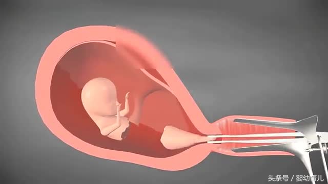 人工流产的胎儿会变成什么样,人工流产胚胎会不会活