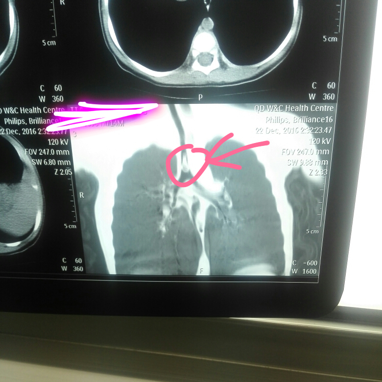 孩子呛着怎么办,孩子呛着了怎么办