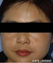 斑点和暗黄有什么区别,褐青色斑什么季节做比较好