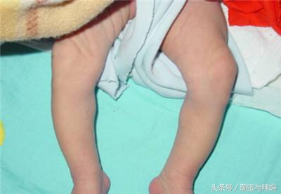 婴儿罗圈腿应如何改正,宝宝罗圈腿怎么造成的