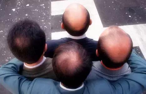 教你一招告别脱发掉发,90后脱发自救的秘方