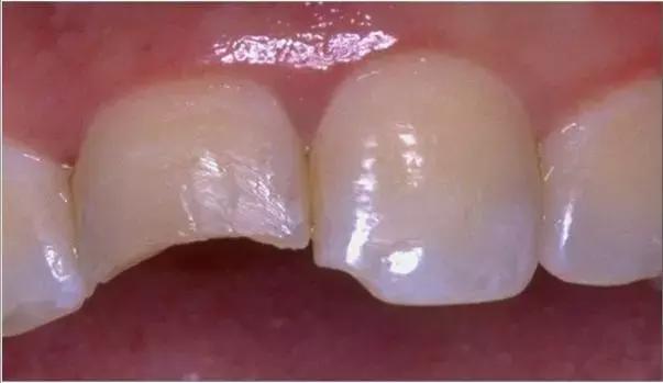 牙齿摔倒掉了一半补牙全过程,一颗牙齿脱落补牙