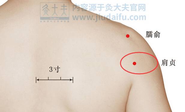艾灸治疗肩周炎,是健康安全的优选方案