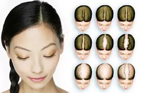 教你一招告别脱发掉发,90后脱发自救的秘方