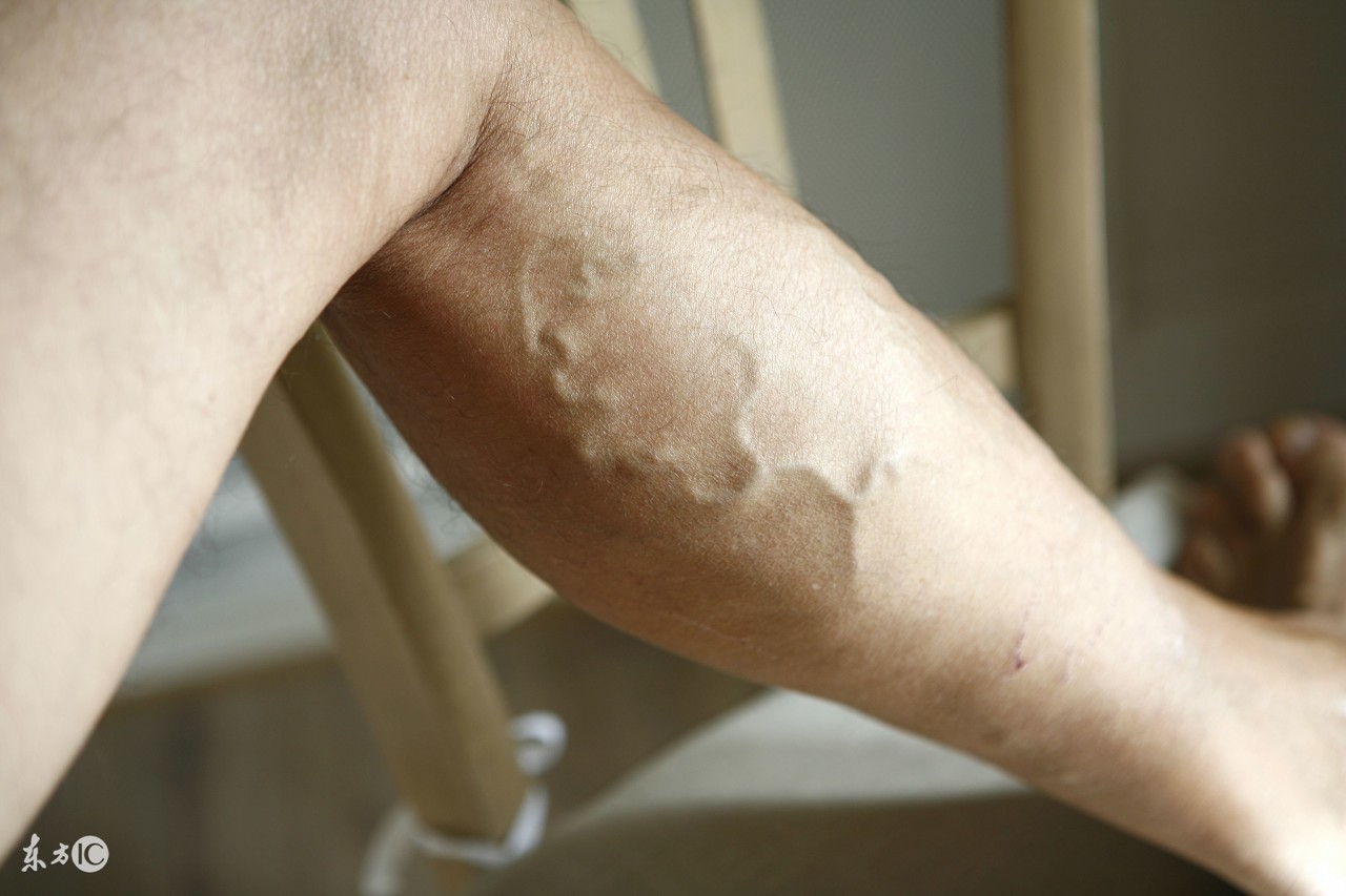 遗传下肢静脉曲张吃什么药预防,静脉曲张是显性遗传还是隐性遗传