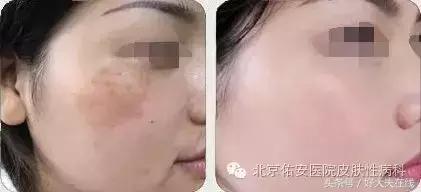 褐斑的最佳治疗方法,褐青斑最佳的治疗方法