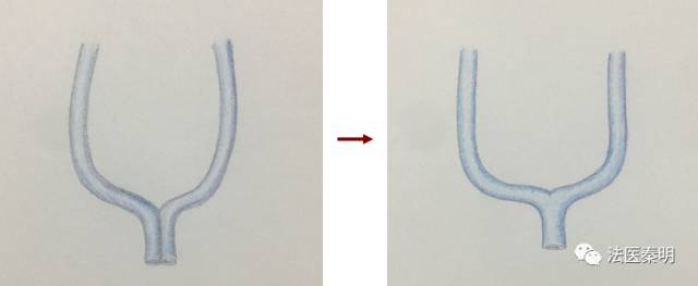 女人有两个子宫怎么办呢,来大姨妈可以同宫吗