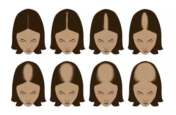 关于脱发你需要知道这10个真相,关于脱发你必须知道的真相