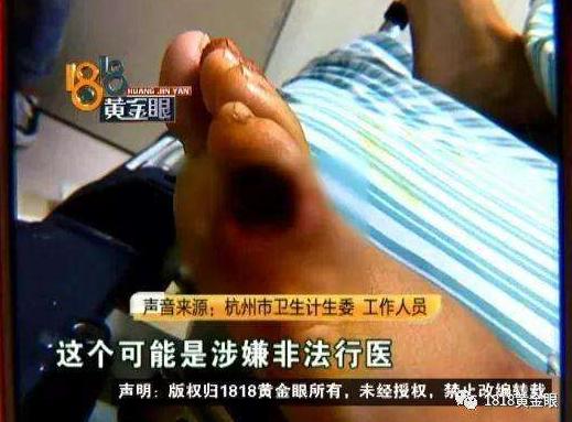 脚上长奇怪的东西是什么,脚上长了一个奇怪东西