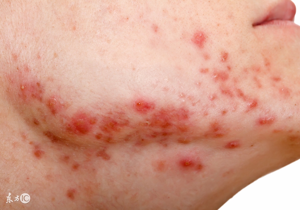 暗疮原因,暗疮形成原理