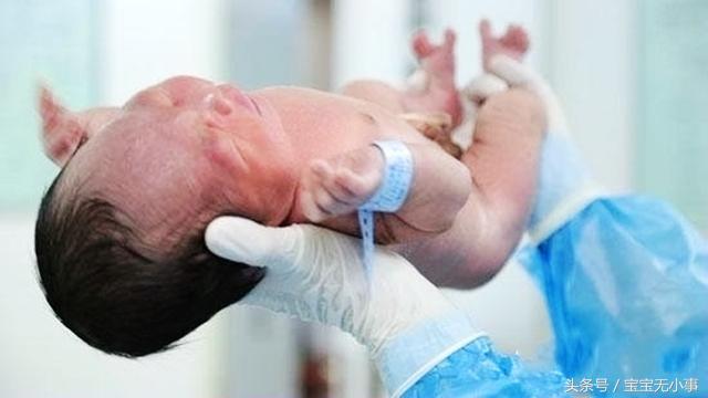 顺产宝宝头被夹尖什么时候能恢复,生宝宝时头被夹会恢复吗