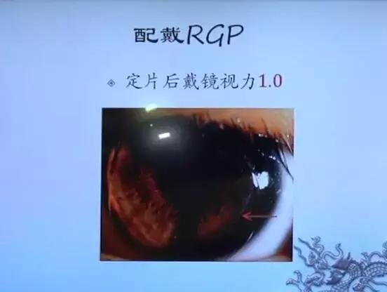 徐建江教授：角膜移植术后屈光不正的矫正