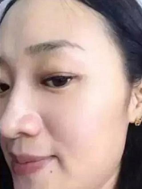 吃维生素c和维生素e能淡化痘印吗,维生素e软胶囊可以祛除痘印吗