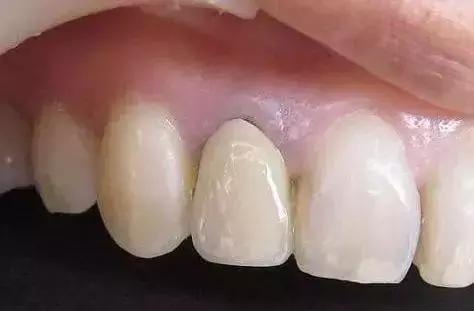 做烤瓷牙后悔的人,做烤瓷牙的人都后悔吗