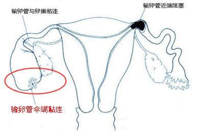 输卵管粘连的症状,盆腔输卵管粘连症状