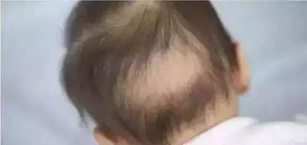 油腻中年人越来越年轻化，2岁大的孩子狂掉头发