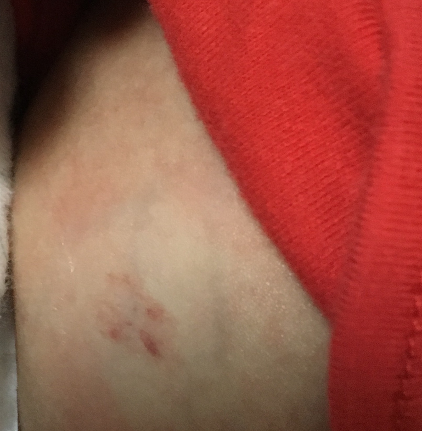 宝宝草莓状血管瘤不可怕，早发现，早治疗，附贴药操作视频