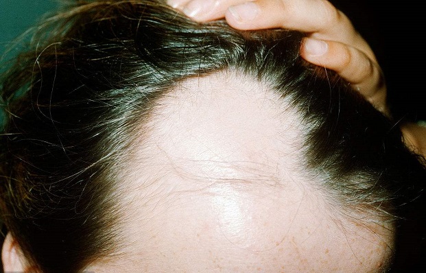 顶部脱发最快的治疗方法,筋膜放松改善脱发