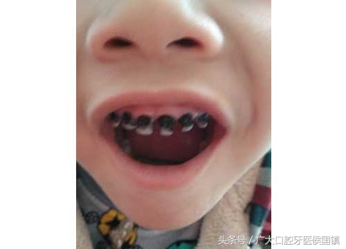 不抽烟牙齿变黑是什么原因,小孩的牙齿变黑是什么原因