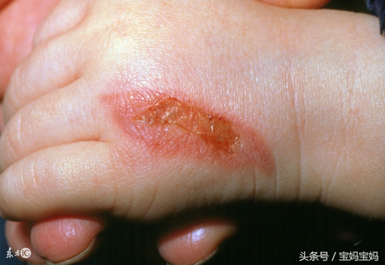 宝宝烫伤的正确处理方式,宝宝烫伤怎么处理好得快轻微