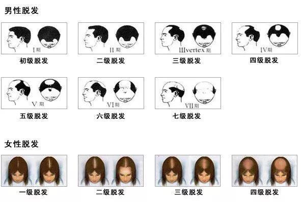 脂溢性脱发有遗传吗,脂溢性脱发有什么偏方