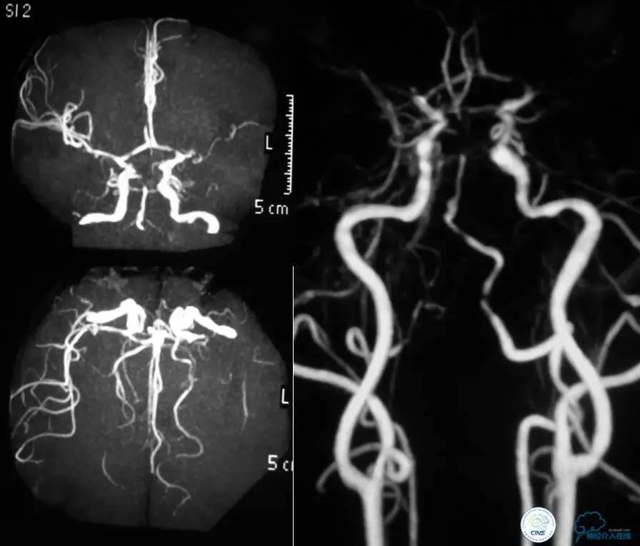 急性缺血性卒中静脉溶栓2018指南,急性缺血性卒中血管内再通标准