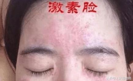 激素依赖性皮炎使用哪些中药,护肤品依赖性皮炎