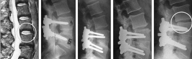 腰椎间盘突出症术后又犯腰腿痛?锻炼腰背肌就能有效避免