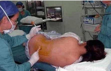 剖腹产一周后产妇伤口崩开,剖腹产刀口崩裂怎么处理