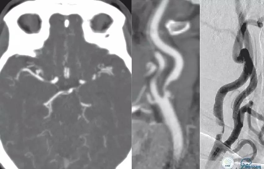 急性缺血性卒中静脉溶栓2018指南,急性缺血性卒中血管内再通标准