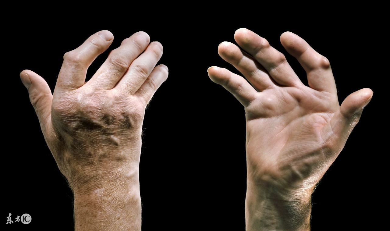 甲氨蝶呤治疗类风湿病效果,甲氨蝶呤能治风湿和类风湿吗