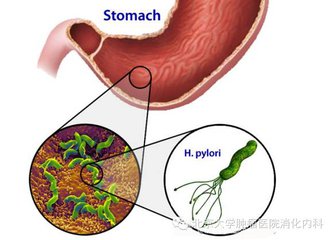 如何治疗幽门螺杆菌最好的方法,治疗幽门螺杆菌最佳根除法
